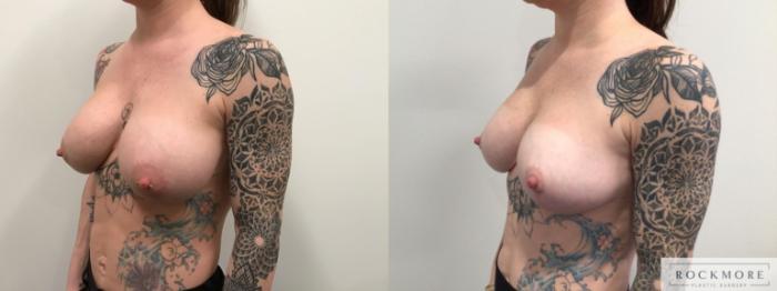 Before & After Breast Augmentation Revision Case 436 Left Oblique View in Albany & Latham, New York