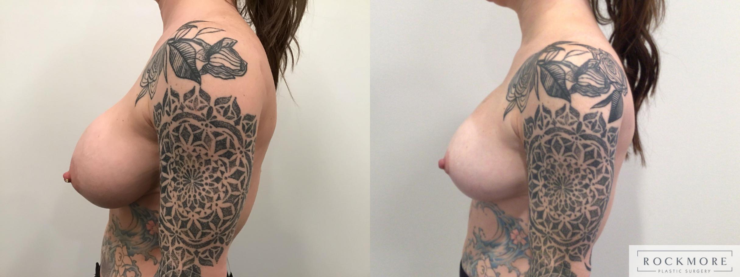 Before & After Breast Augmentation Revision Case 436 Left Side View in Albany & Latham, New York