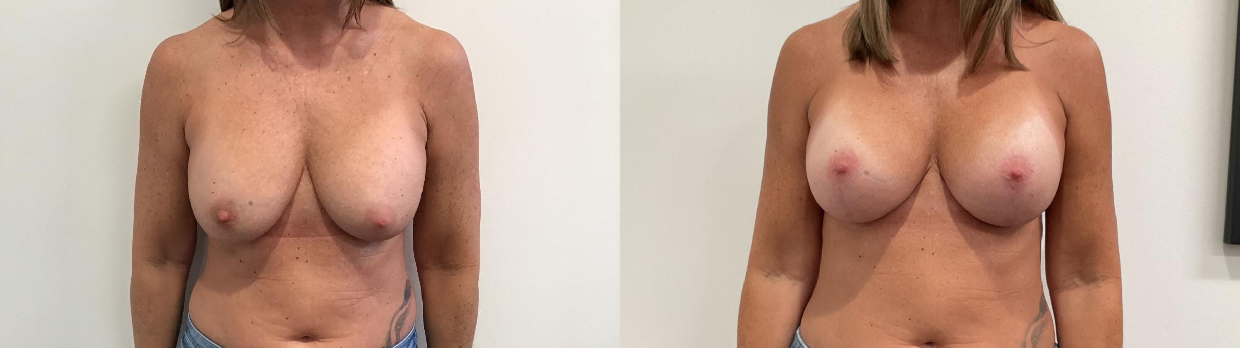 Before & After Breast Augmentation Revision Case 473 Front View in Albany, Latham & Saratoga, New York