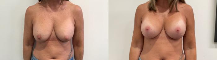 Before & After Breast Augmentation Revision Case 473 Front View in Albany, Latham & Saratoga, New York