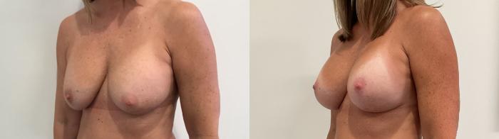 Before & After Breast Augmentation Revision Case 473 Left Oblique View in Albany, Latham & Saratoga, New York