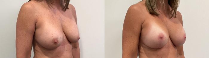 Before & After Breast Augmentation Revision Case 473 Right Oblique View in Albany, Latham & Saratoga, New York