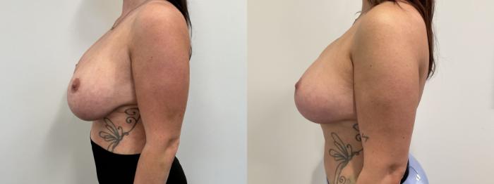 Before & After Breast Augmentation Revision Case 475 Left Side View in Albany, Latham & Saratoga, New York