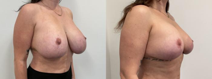 Before & After Breast Augmentation Revision Case 475 Right Oblique View in Albany, Latham & Saratoga, New York