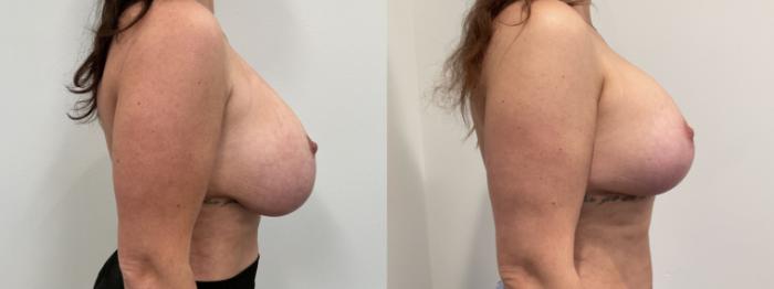 Before & After Breast Augmentation Revision Case 475 Right Side View in Albany, Latham & Saratoga, New York