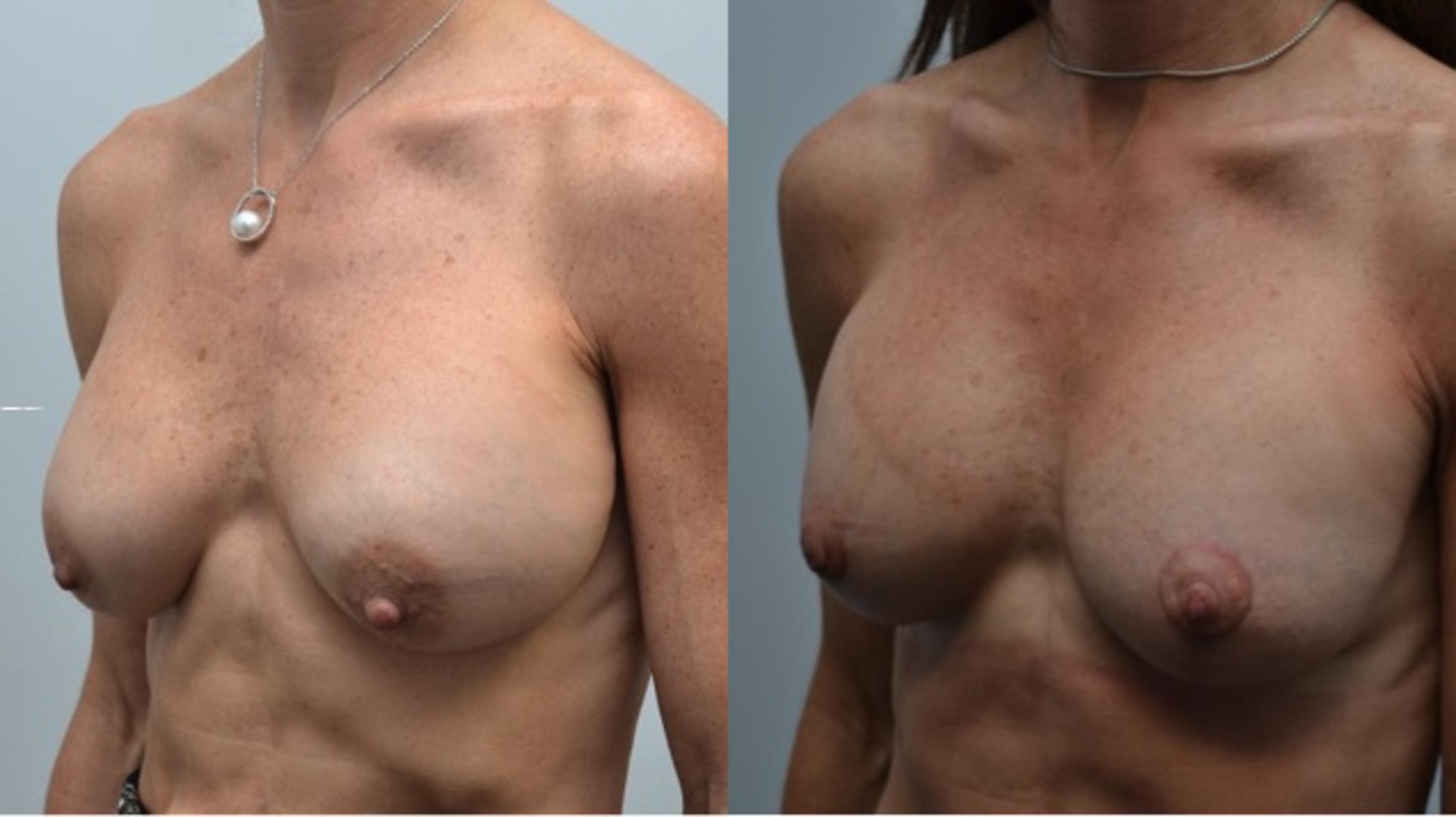 Before & After Breast Augmentation Revision Case 251 View #3 View in Albany & Latham, New York