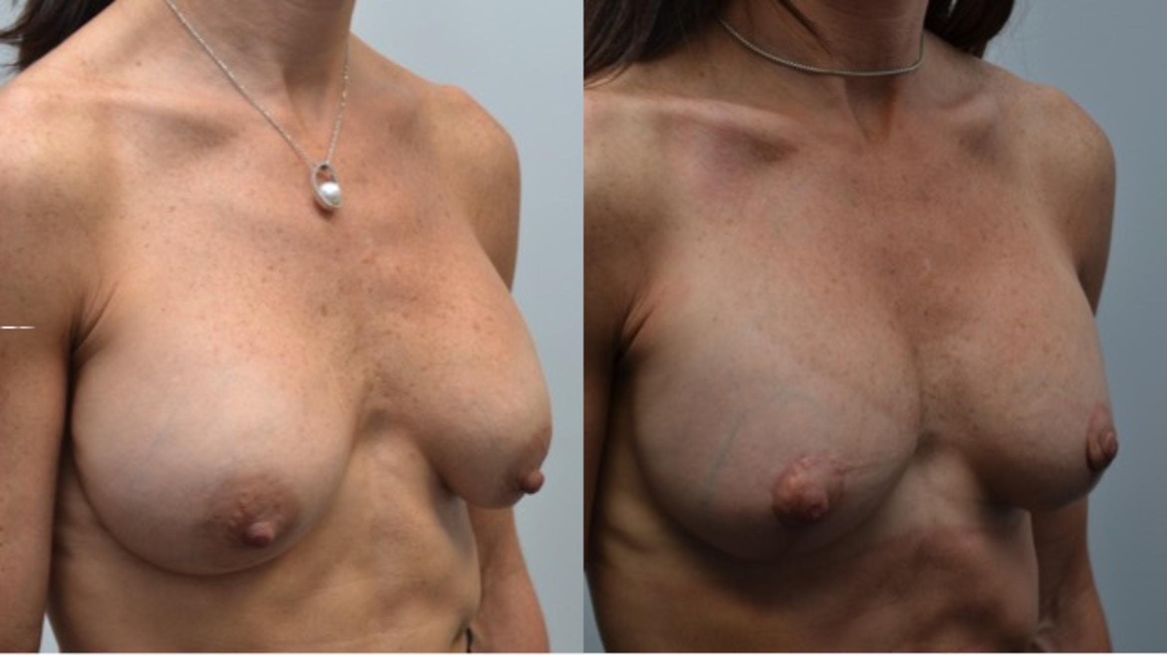 Before & After Breast Augmentation Revision Case 251 View #5 View in Albany & Latham, New York