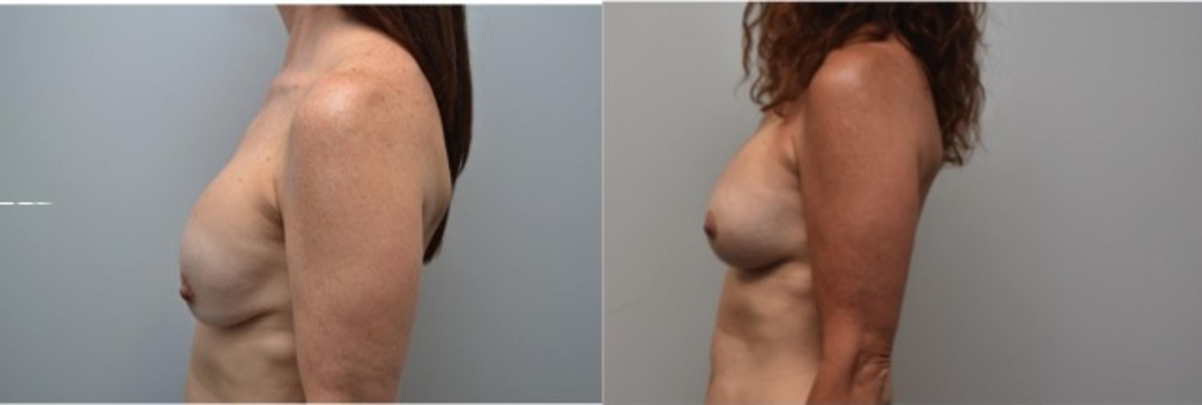 Before & After Breast Augmentation Revision Case 291 View #2 View in Albany & Latham, New York