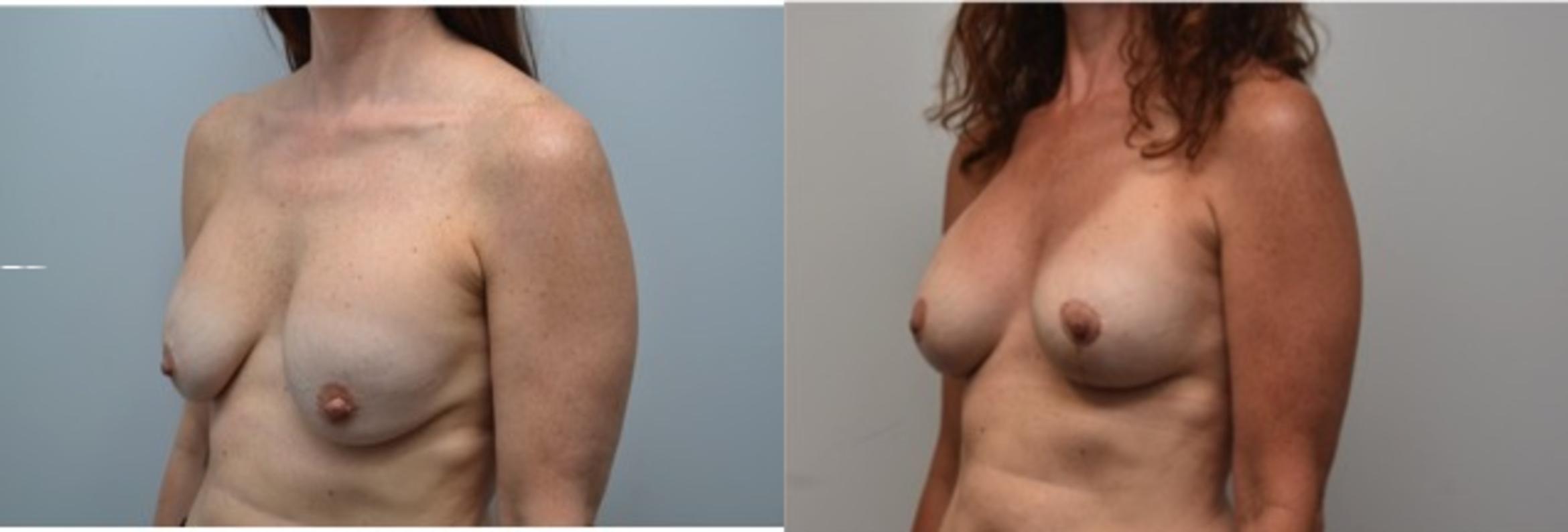 Before & After Breast Augmentation Revision Case 291 View #3 View in Albany & Latham, New York