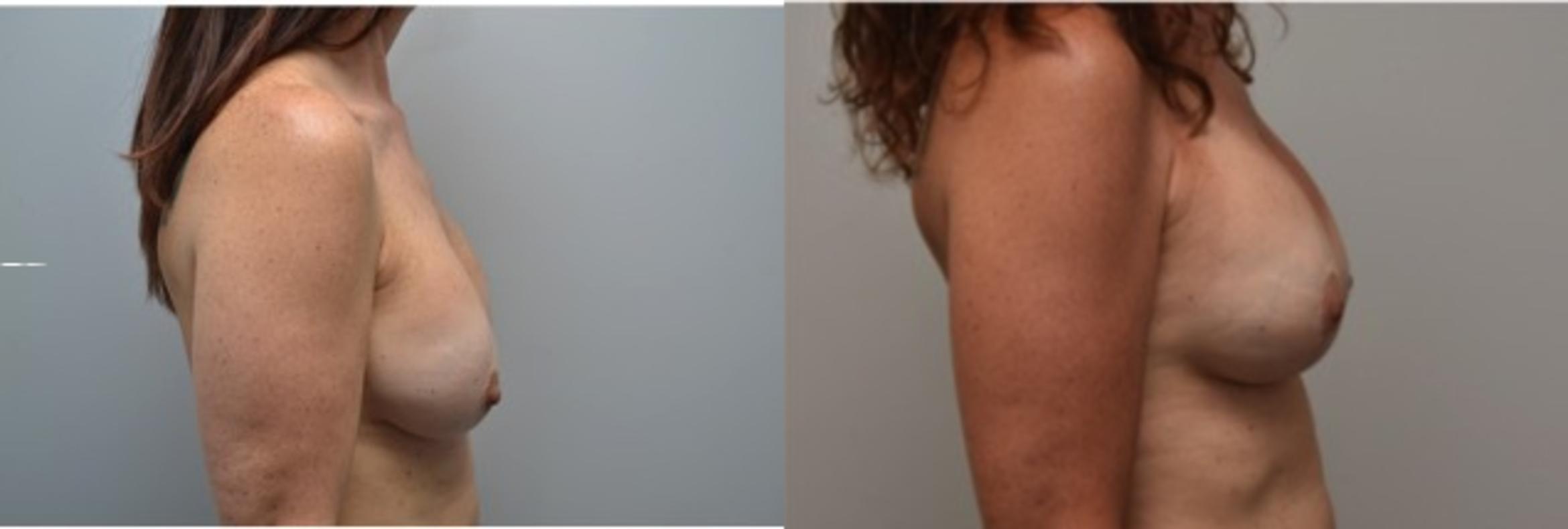 Before & After Breast Augmentation Revision Case 291 View #4 View in Albany & Latham, New York