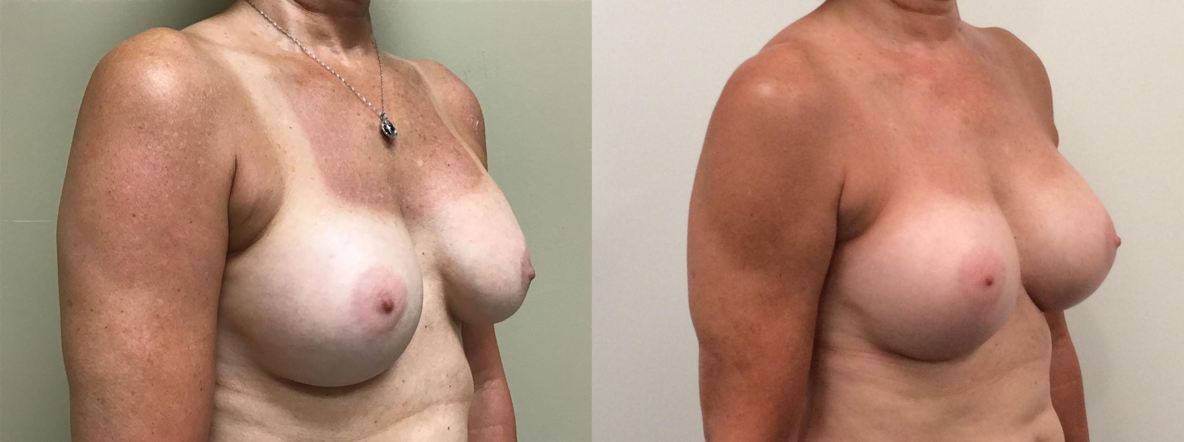 Before & After Breast Augmentation Revision Case 381 Right Oblique View in Albany & Latham, New York