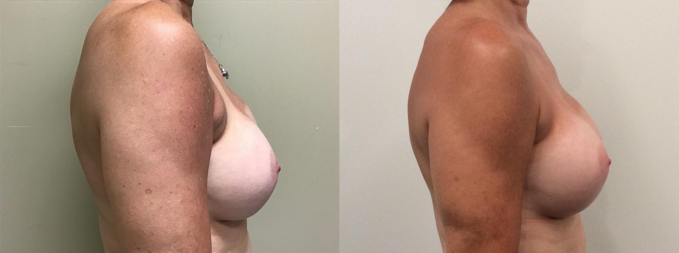Before & After Breast Augmentation Revision Case 381 Right Side View in Albany & Latham, New York