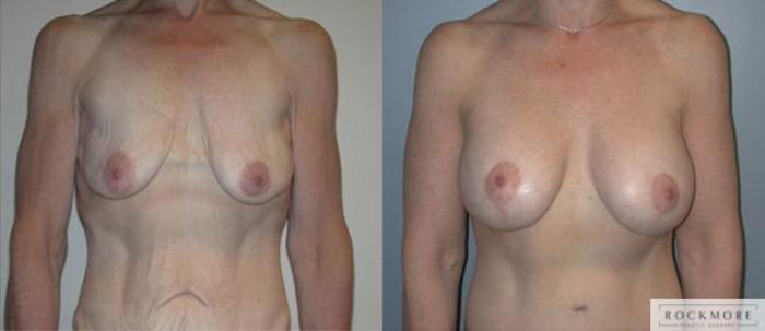 Before & After Breast Lift Case 119 View #1 View in Albany & Latham, New York