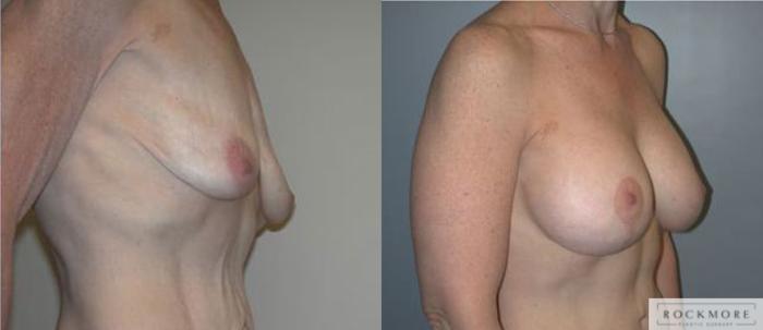 Before & After Breast Lift Case 119 View #2 View in Albany & Latham, New York
