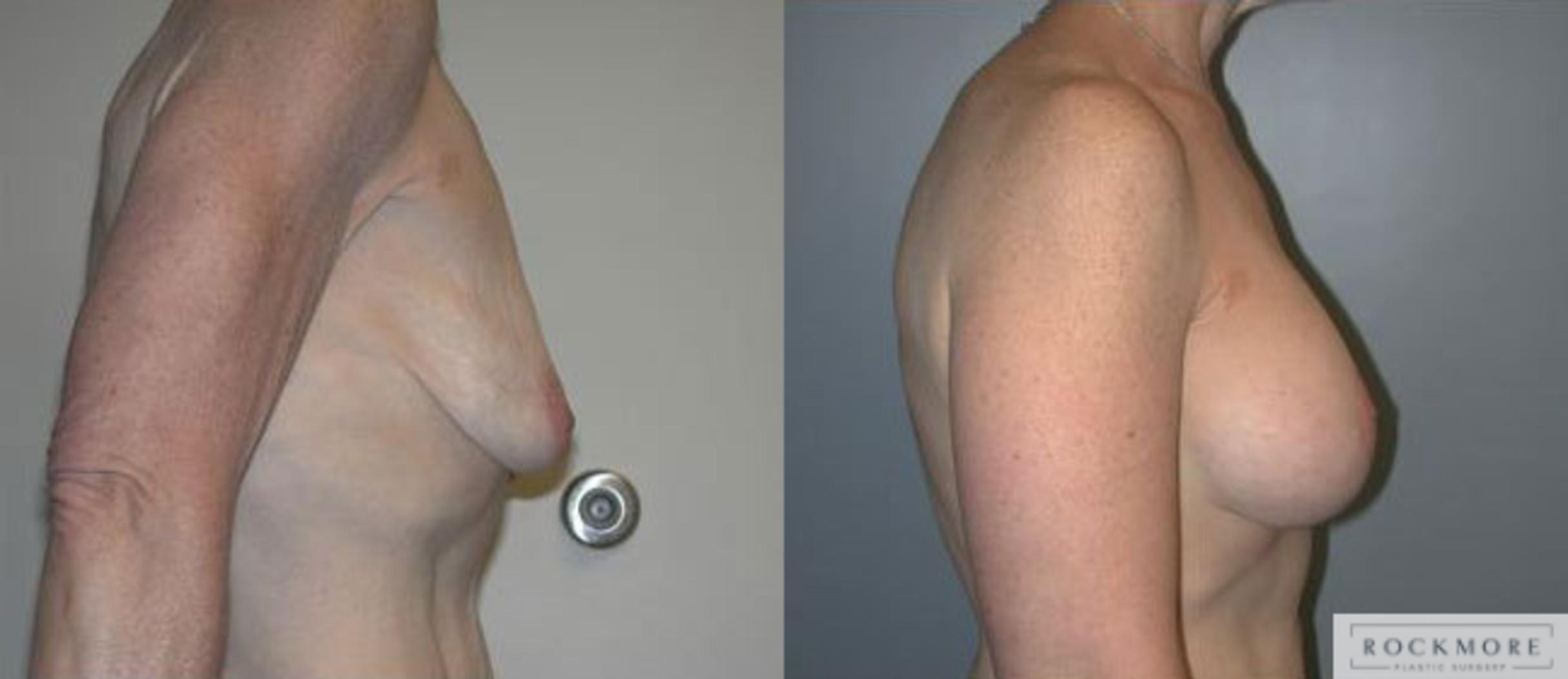 Before & After Breast Lift Case 119 View #3 View in Albany & Latham, New York