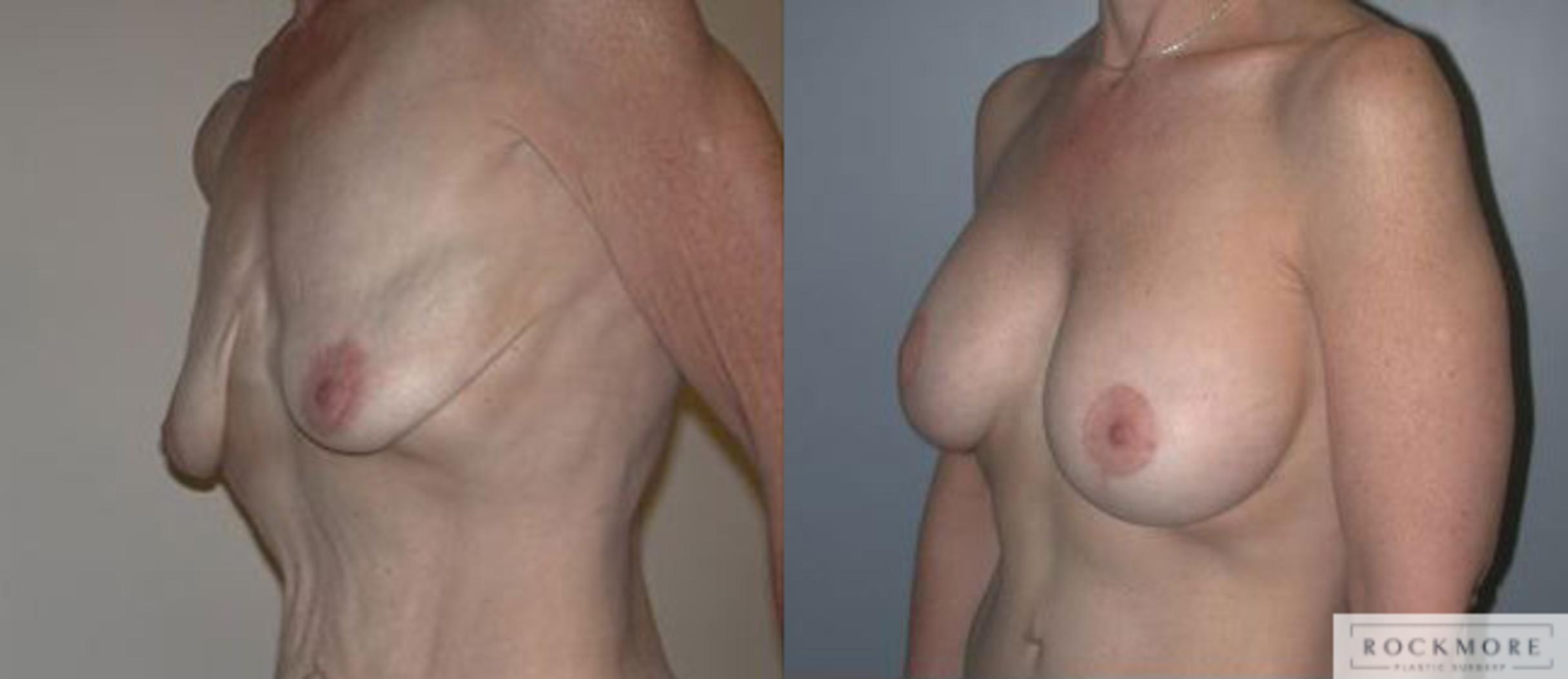 Before & After Breast Lift Case 119 View #4 View in Albany & Latham, New York