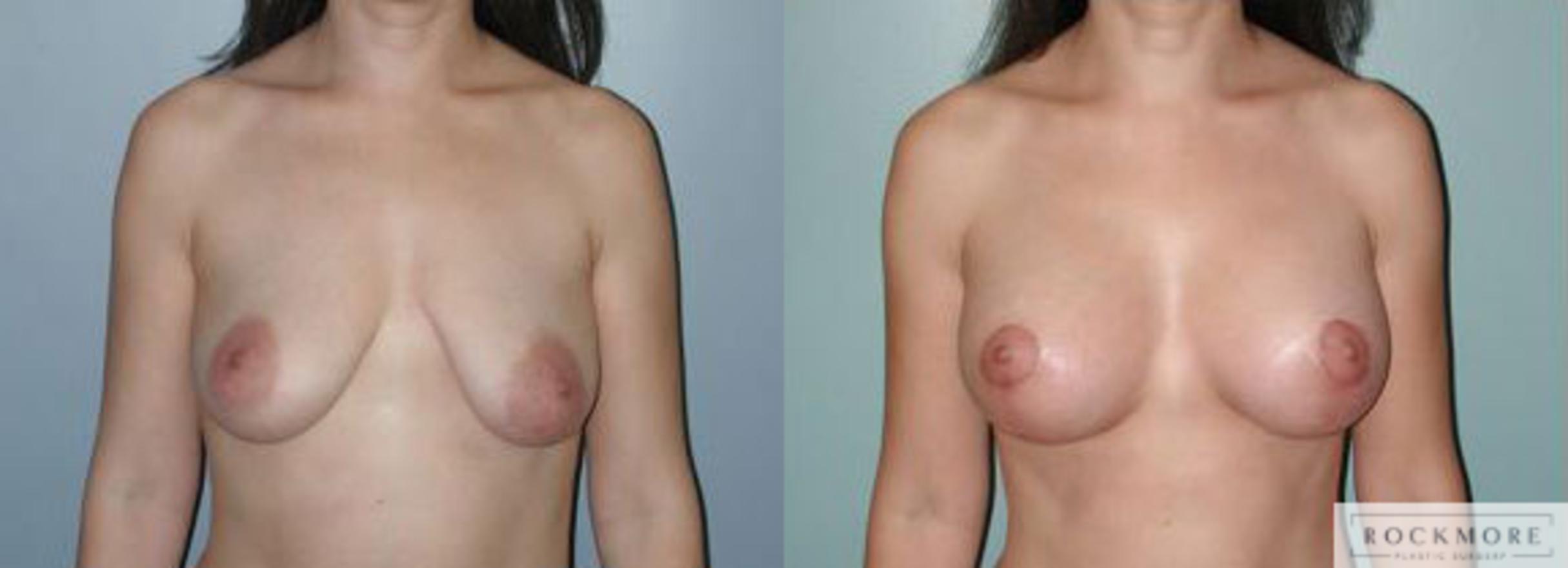 Before & After Breast Lift Case 121 View #1 View in Albany & Latham, New York