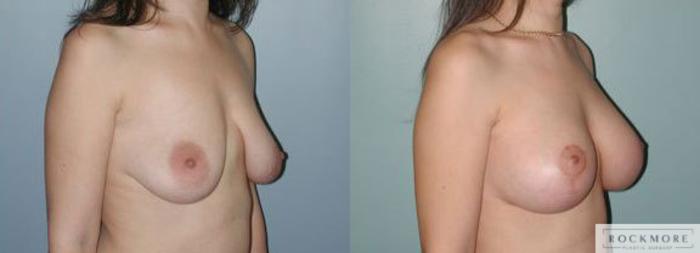 Before & After Breast Lift Case 121 View #2 View in Albany & Latham, New York