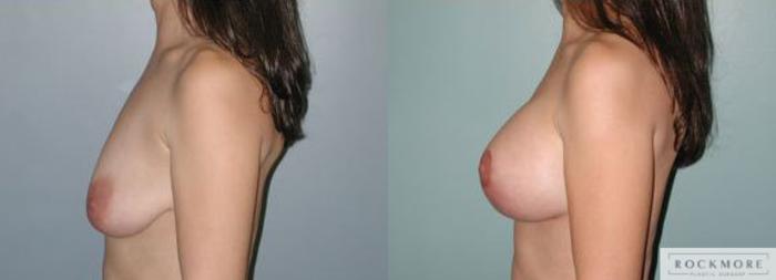 Before & After Breast Lift Case 121 View #3 View in Albany & Latham, New York