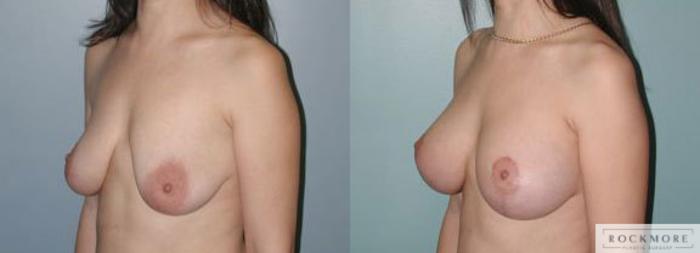 Before & After Breast Lift Case 121 View #4 View in Albany & Latham, New York