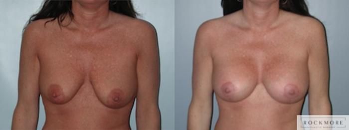 Before & After Breast Lift Case 143 View #1 View in Albany & Latham, New York