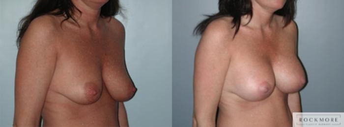 Before & After Breast Lift Case 143 View #2 View in Albany & Latham, New York