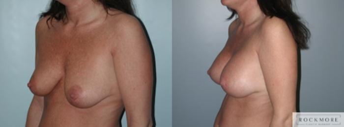 Before & After Breast Lift Case 143 View #3 View in Albany & Latham, New York