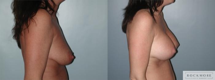 Before & After Breast Lift Case 143 View #4 View in Albany & Latham, New York