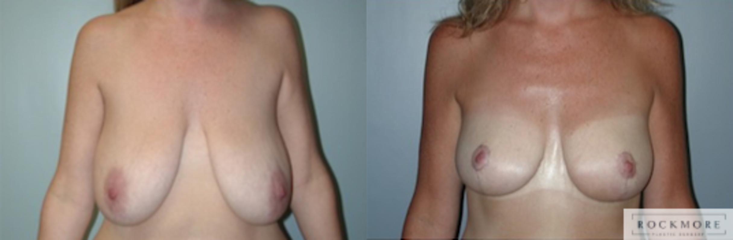 Before & After Breast Lift Case 144 View #1 View in Albany & Latham, New York