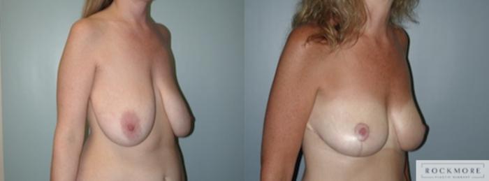 Before & After Breast Lift Case 144 View #2 View in Albany & Latham, New York
