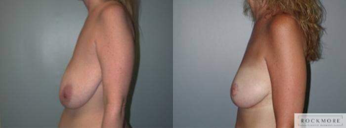 Before & After Breast Lift Case 144 View #4 View in Albany & Latham, New York