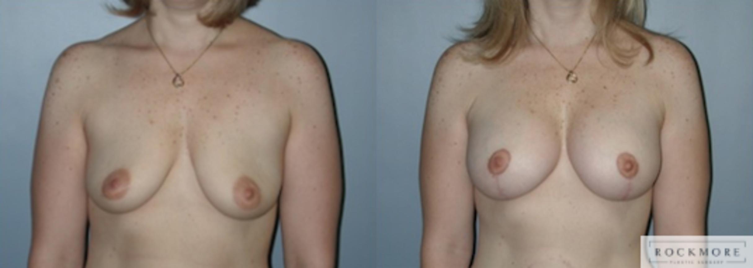 Before & After Breast Lift Case 146 View #1 View in Albany & Latham, New York