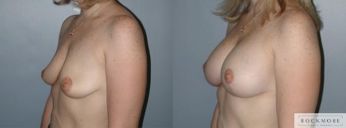 Before & After Breast Lift Case 146 View #2 View in Albany & Latham, New York