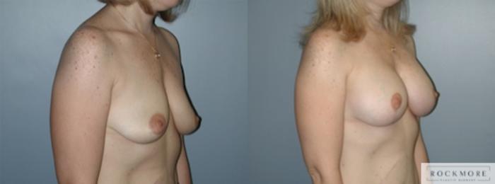 Before & After Breast Lift Case 146 View #3 View in Albany & Latham, New York