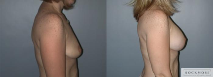 Before & After Breast Lift Case 146 View #4 View in Albany & Latham, New York
