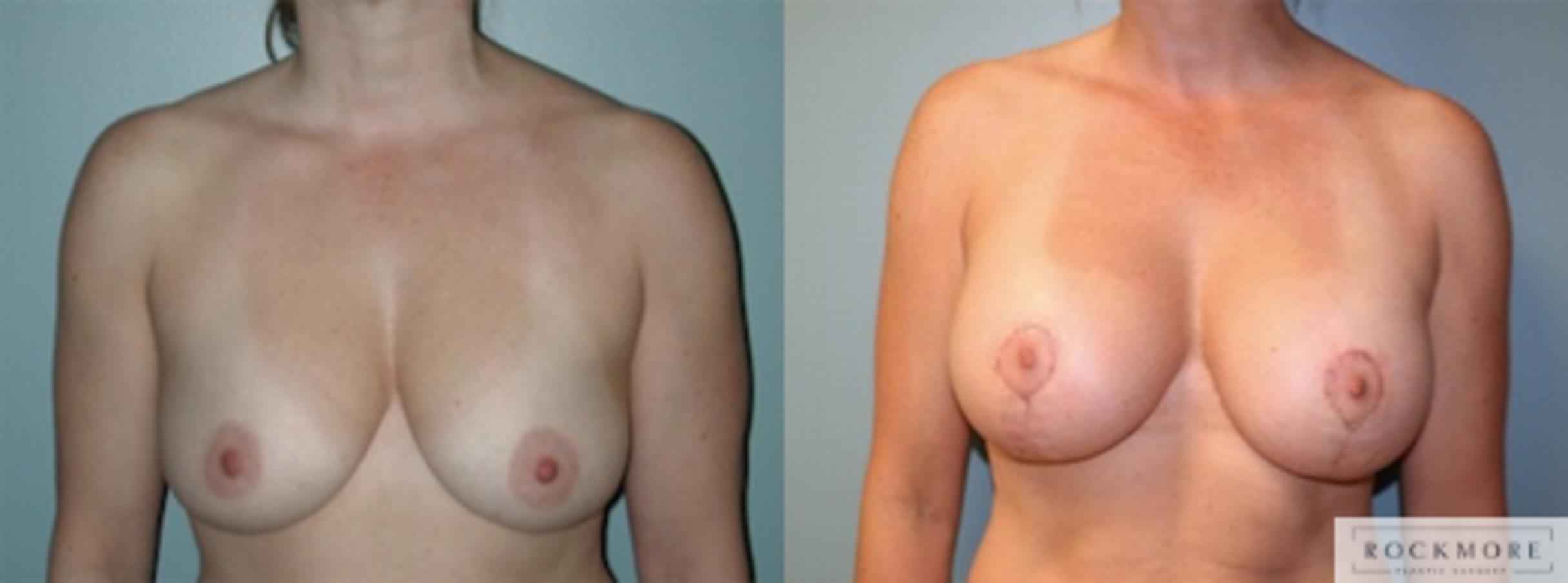 Before & After Breast Lift Case 147 View #1 View in Albany & Latham, New York