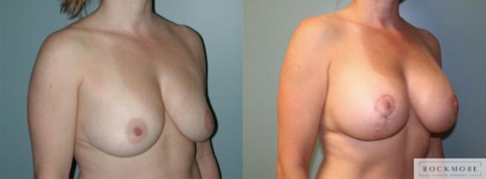 Before & After Breast Lift Case 147 View #2 View in Albany & Latham, New York
