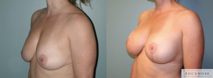 Before & After Breast Lift Case 147 View #3 View in Albany & Latham, New York