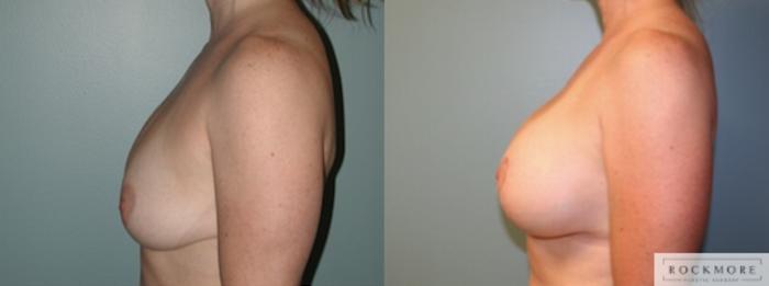Before & After Breast Lift Case 147 View #4 View in Albany & Latham, New York