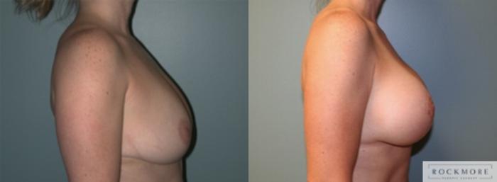 Before & After Breast Lift Case 147 View #5 View in Albany & Latham, New York