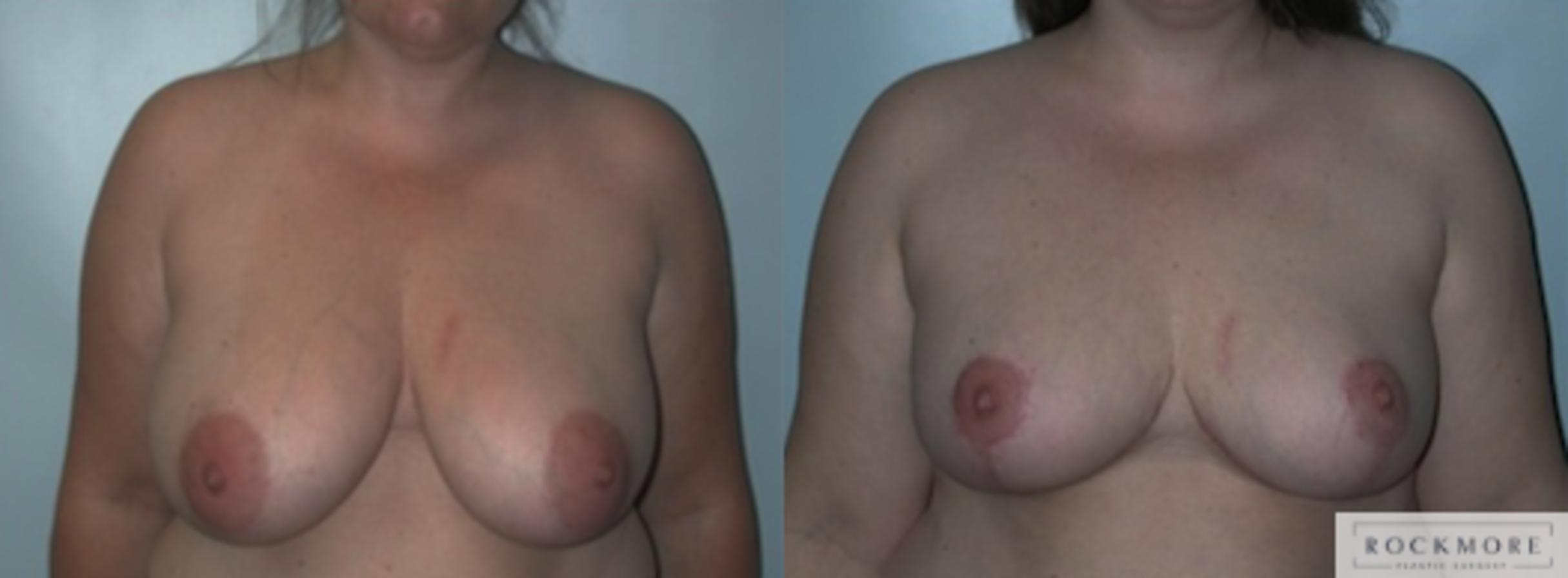 Before & After Breast Lift Case 148 View #1 View in Albany & Latham, New York