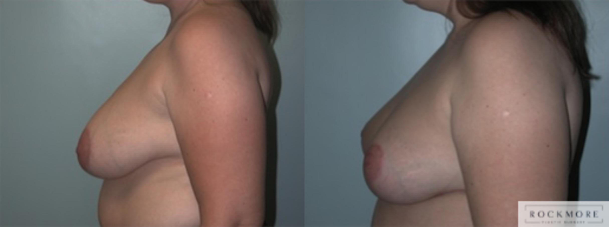 Before & After Breast Lift Case 148 View #2 View in Albany & Latham, New York