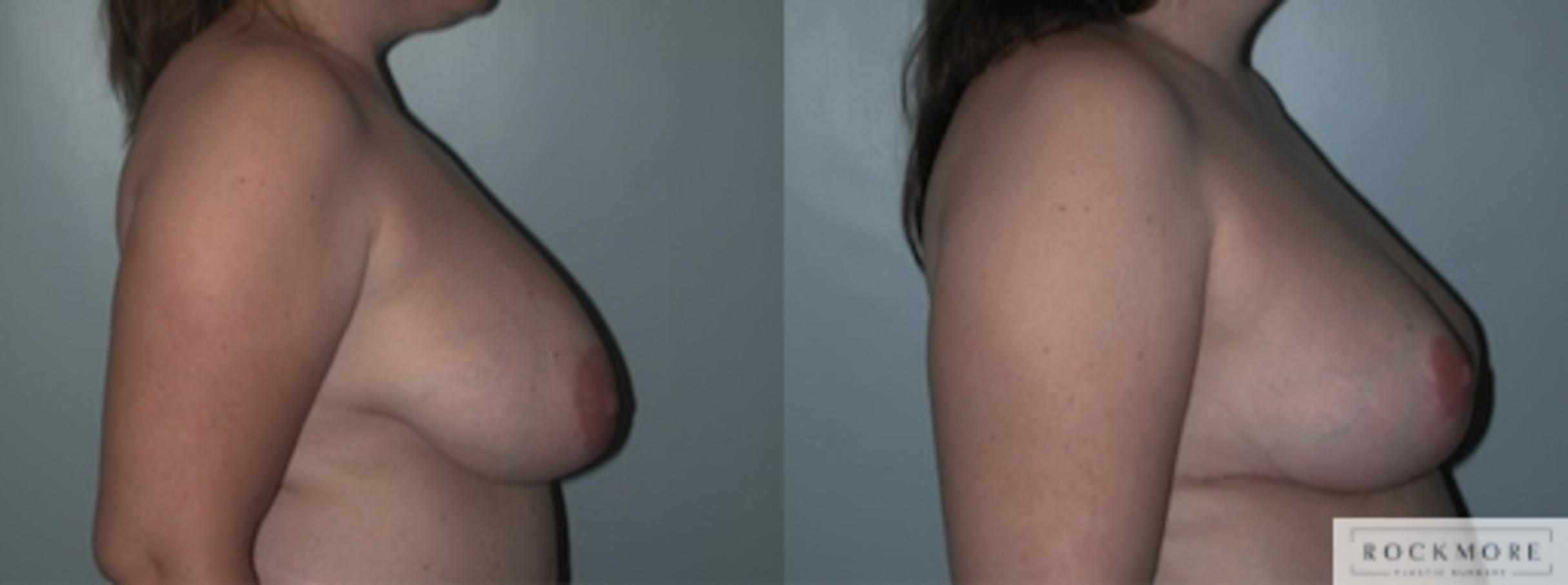 Before & After Breast Lift Case 148 View #3 View in Albany & Latham, New York