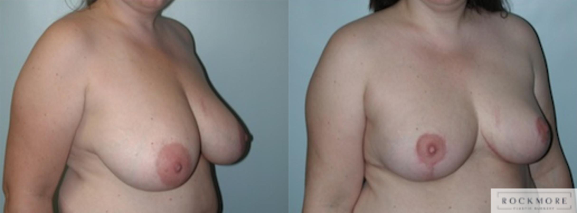 Before & After Breast Lift Case 148 View #4 View in Albany & Latham, New York