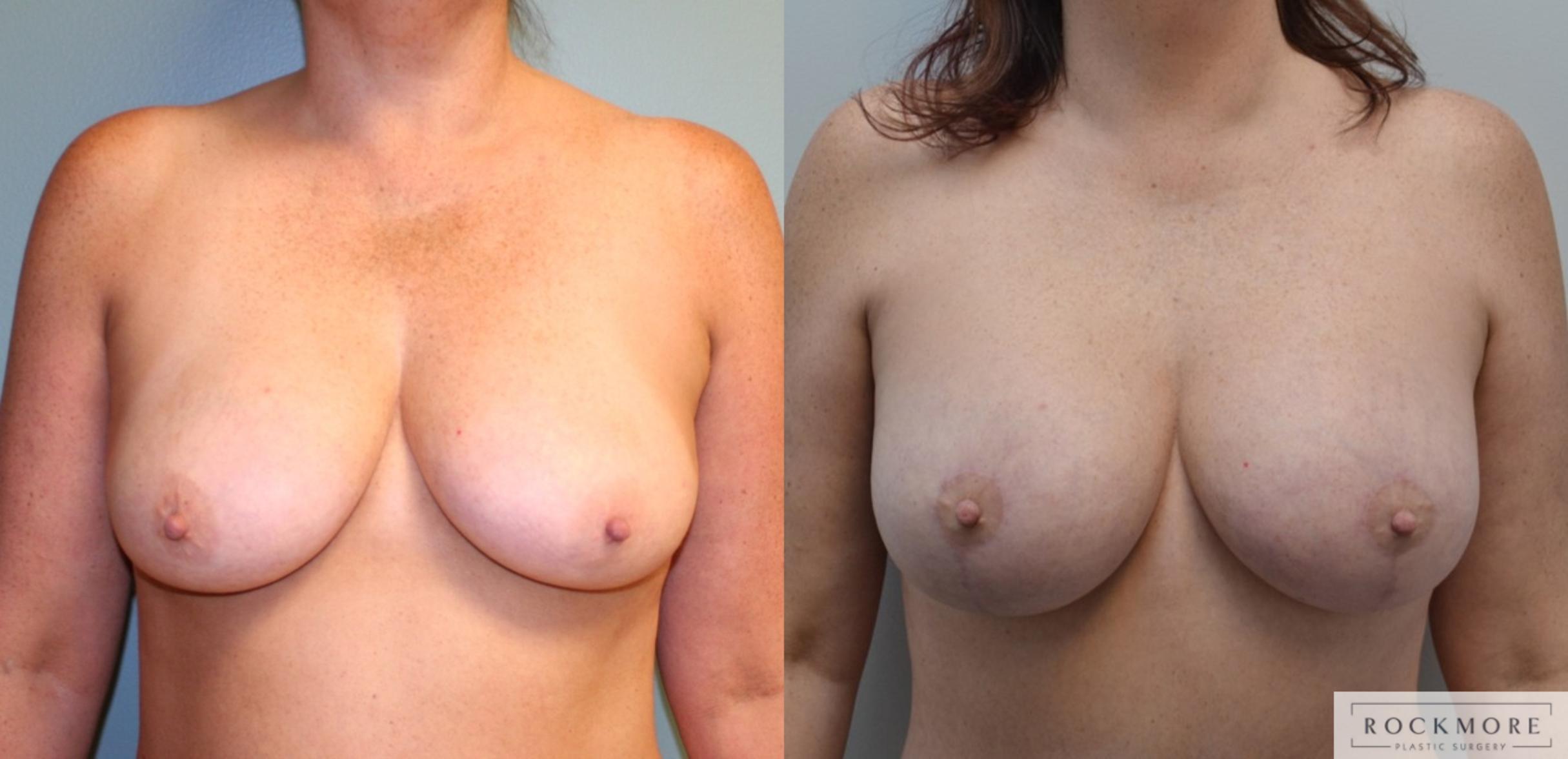 Before & After Breast Lift Case 181 View #1 View in Albany & Latham, New York