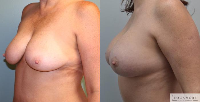 Before & After Breast Lift Case 181 View #2 View in Albany & Latham, New York