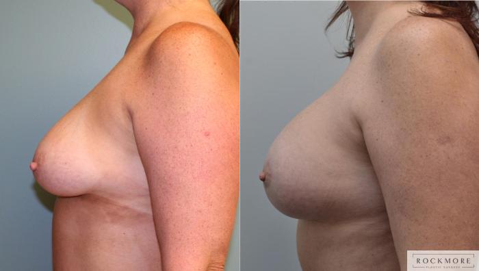 Before & After Breast Lift Case 181 View #3 View in Albany & Latham, New York