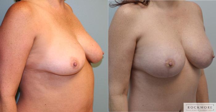 Before & After Breast Lift Case 181 View #4 View in Albany & Latham, New York
