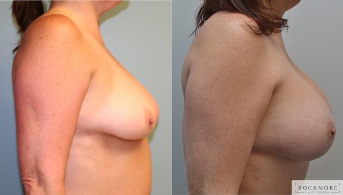 Before & After Breast Lift Case 181 View #5 View in Albany & Latham, New York