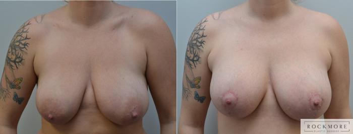 Before & After Breast Lift Case 190 View #1 View in Albany & Latham, New York